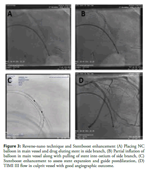 interventional-cardiology-stentboost