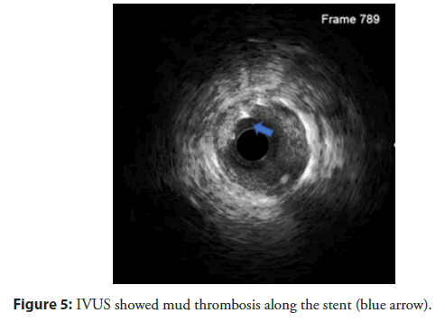 interventional-cardiology-thrombosis