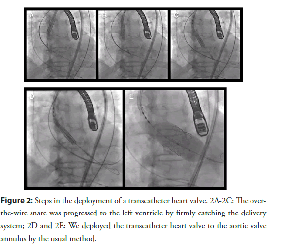 interventional-cardiology-transcatheter