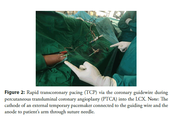 interventional-cardiology-transcoronary