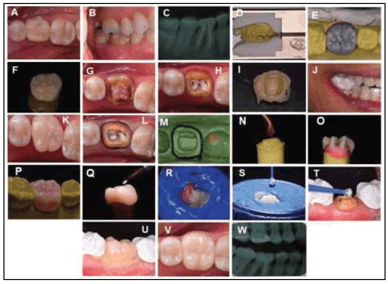 clinical-practice-disilicate