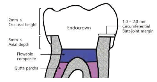 clinical-practice-endocrown