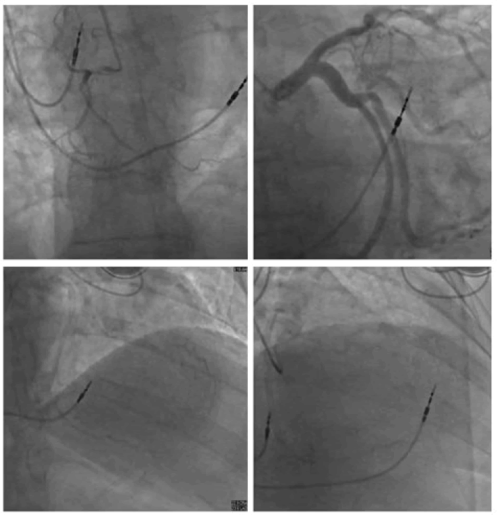 fmci-Coronary