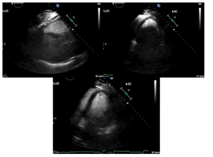 fmci-angiographic