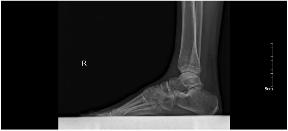 fmci-ankle