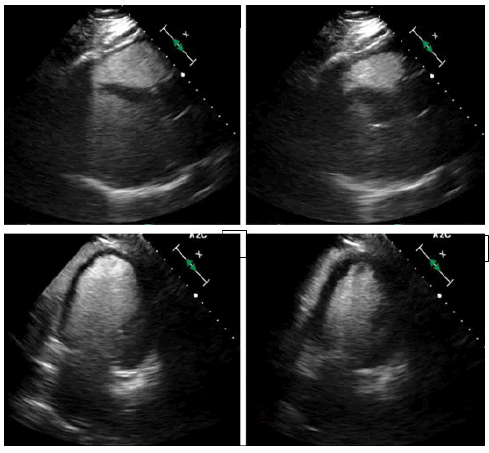 fmci-bi-atrial