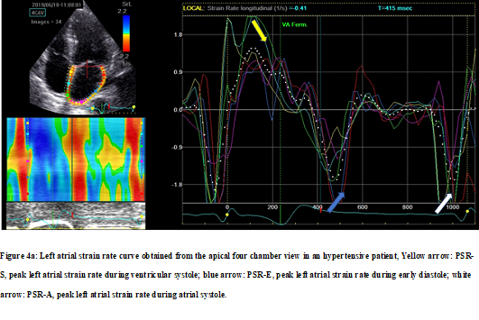 Left Atrial Strain Impairment Precedes Geometric Remodeling as a Marker of  Post-Myocardial Infarction Diastolic Dysfunction - ScienceDirect