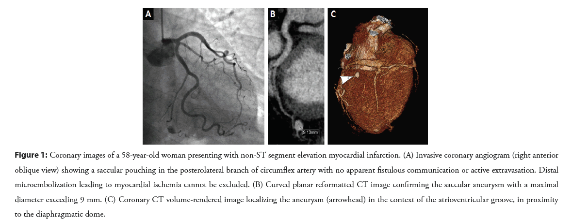 interventional-angiogram