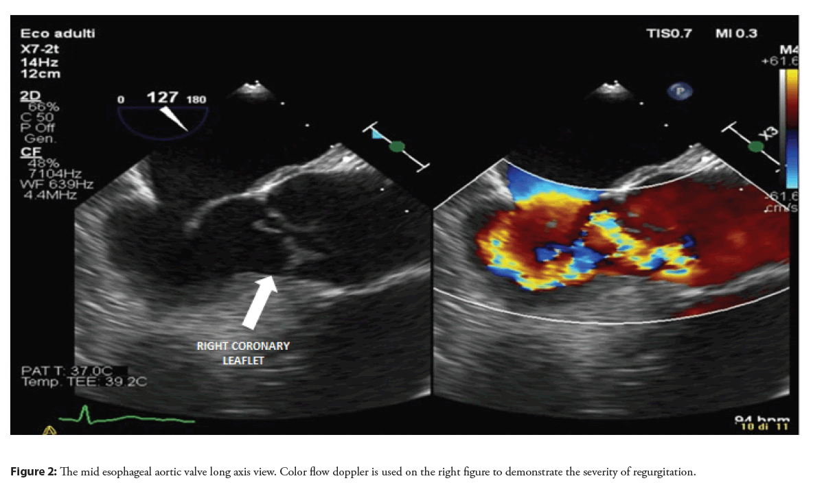 interventional-aortic