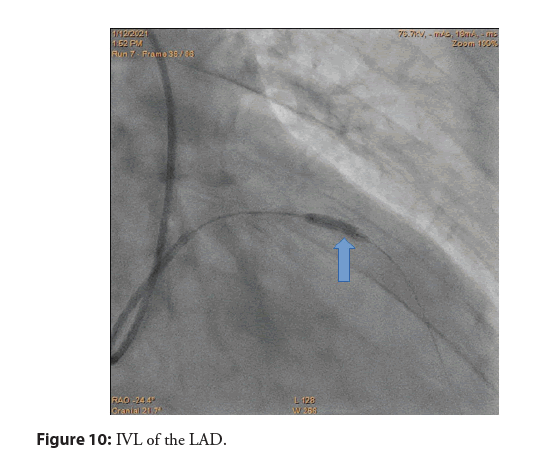 interventional-cardiology-IVL