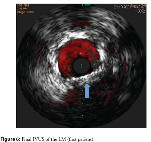 interventional-cardiology-IVUS