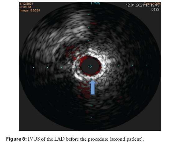 interventional-cardiology-LAD