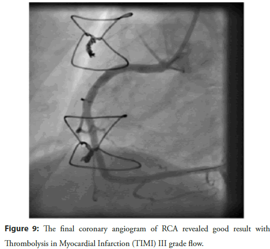interventional-cardiology-angiogram