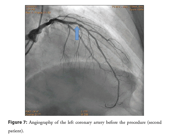 interventional-cardiology-artery