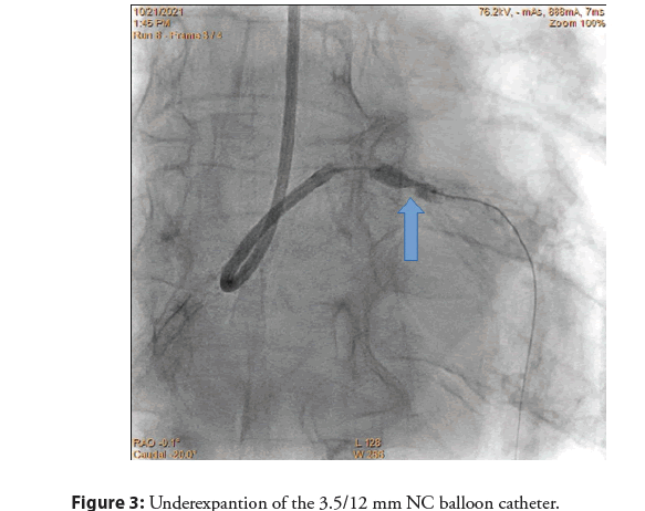 interventional-cardiology-balloon