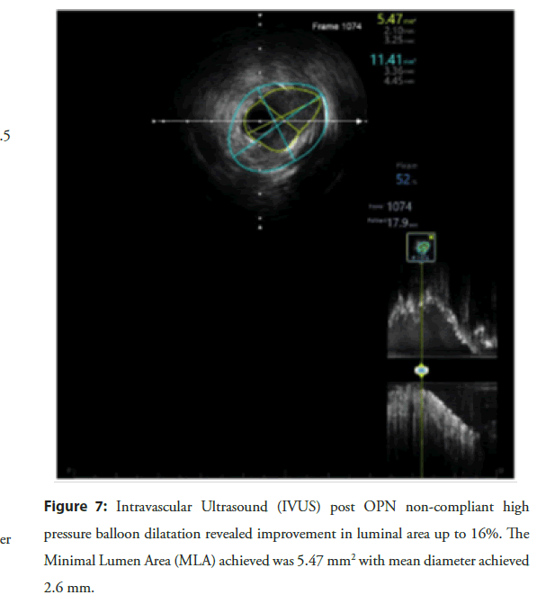 interventional-cardiology-dilatation