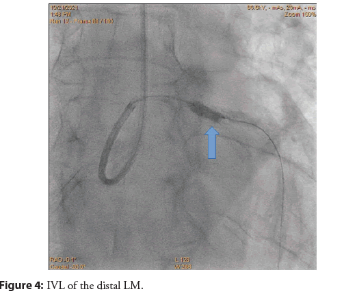 interventional-cardiology-distal