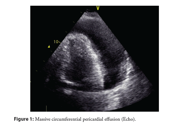 interventional-cardiology-effusion