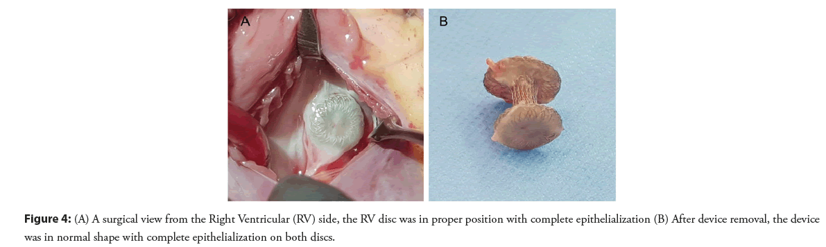 interventional-cardiology-epithelialization