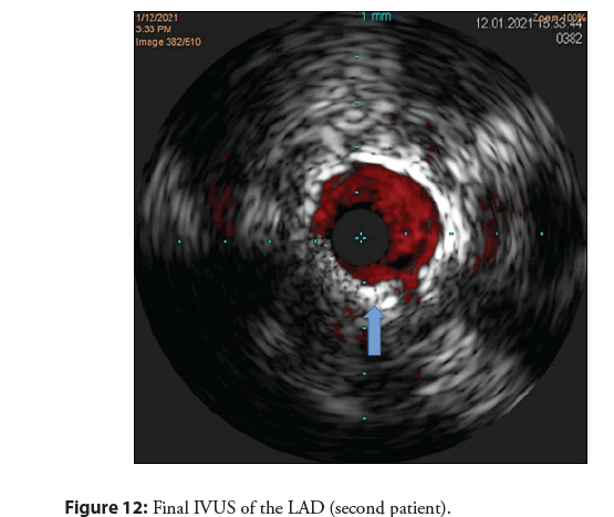 interventional-cardiology-final