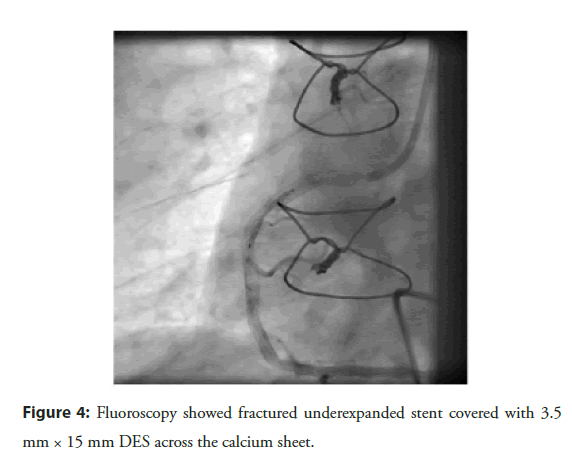 interventional-cardiology-fractured