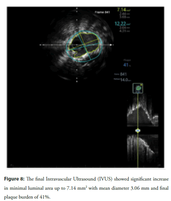 interventional-cardiology-luminal