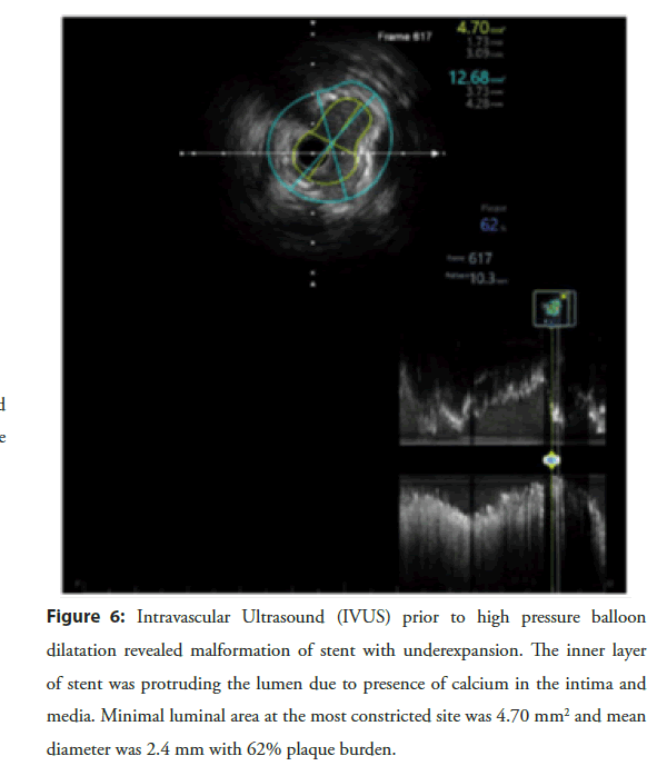 interventional-cardiology-malformation