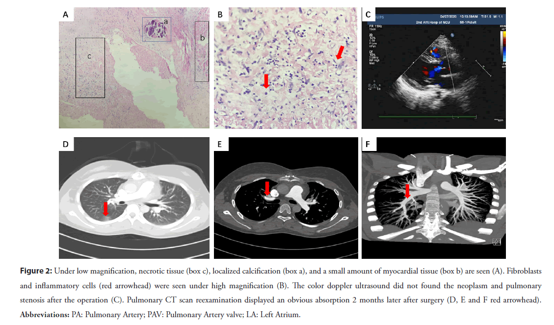 interventional-cardiology-necrotic