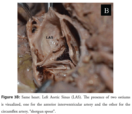 interventional-cardiology-ostiums