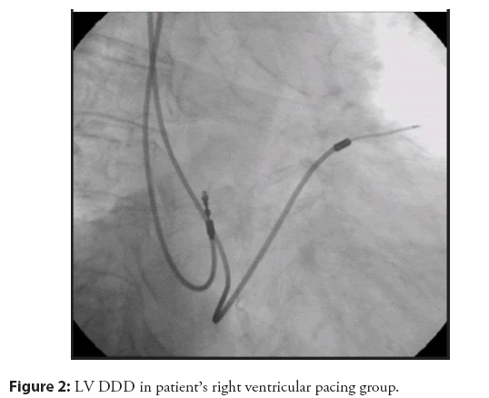 interventional-cardiology-pacing