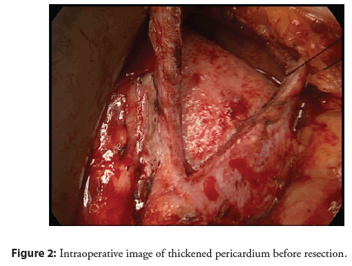 interventional-cardiology-pericardium