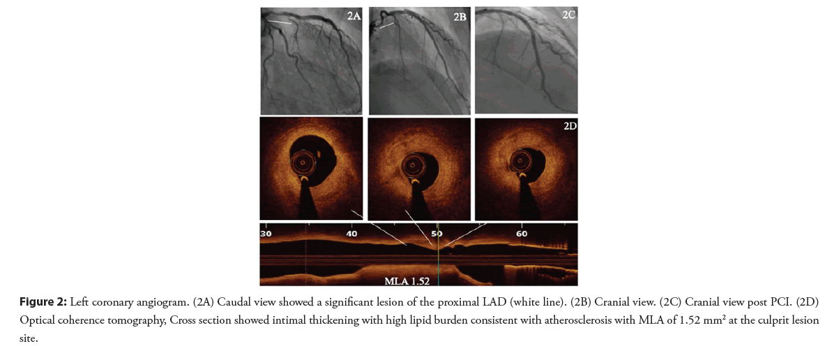 interventional-cardiology-proximal