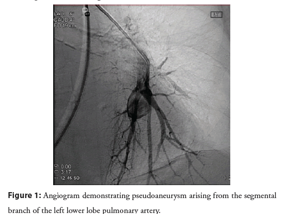 interventional-cardiology-pseudoaneurysm