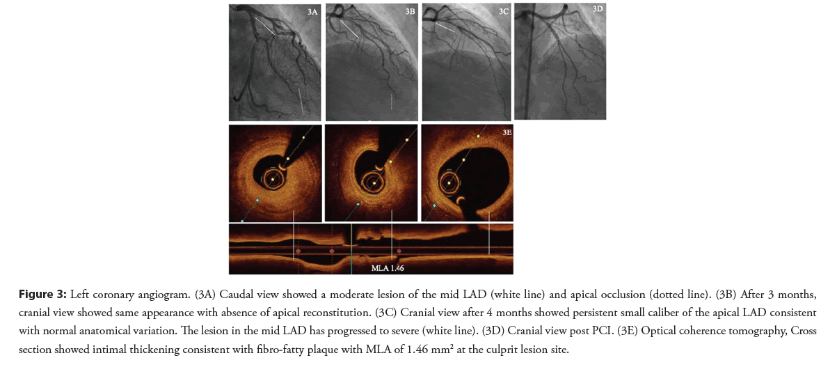 interventional-cardiology-reconstitution