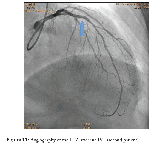 interventional-cardiology-second