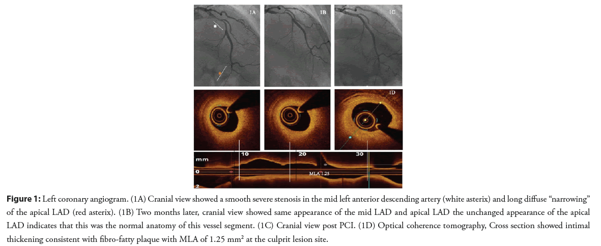 interventional-cardiology-stenosis