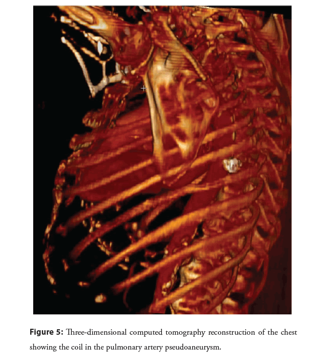 interventional-cardiology-tomography