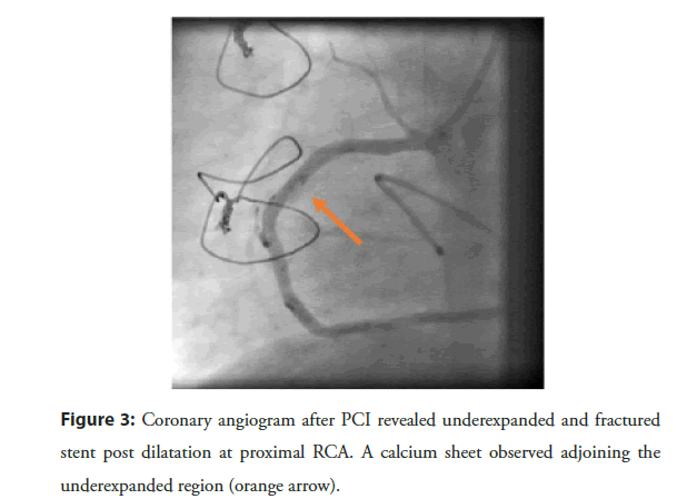interventional-cardiology-underexpanded