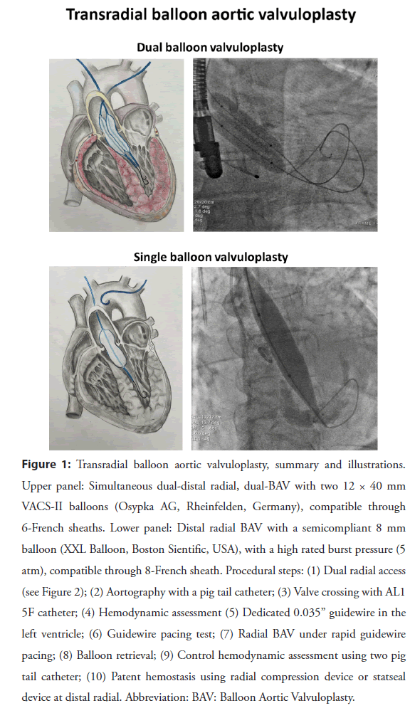 interventional-cardiology-valvuloplasty