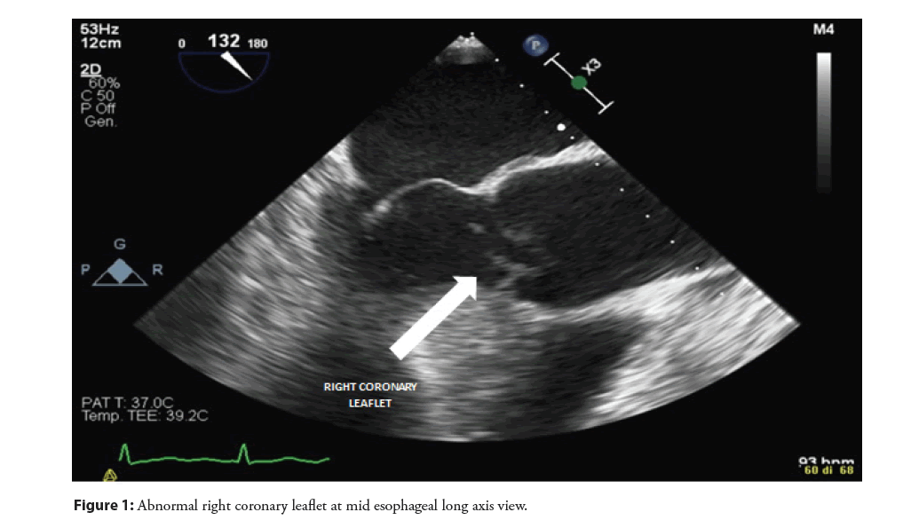 interventional-coronary