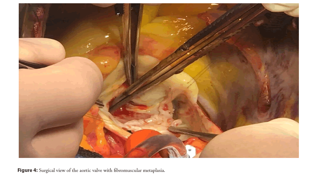 interventional-fibromuscular