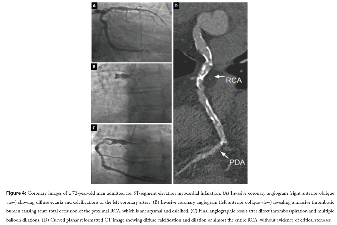 interventional-myocardial