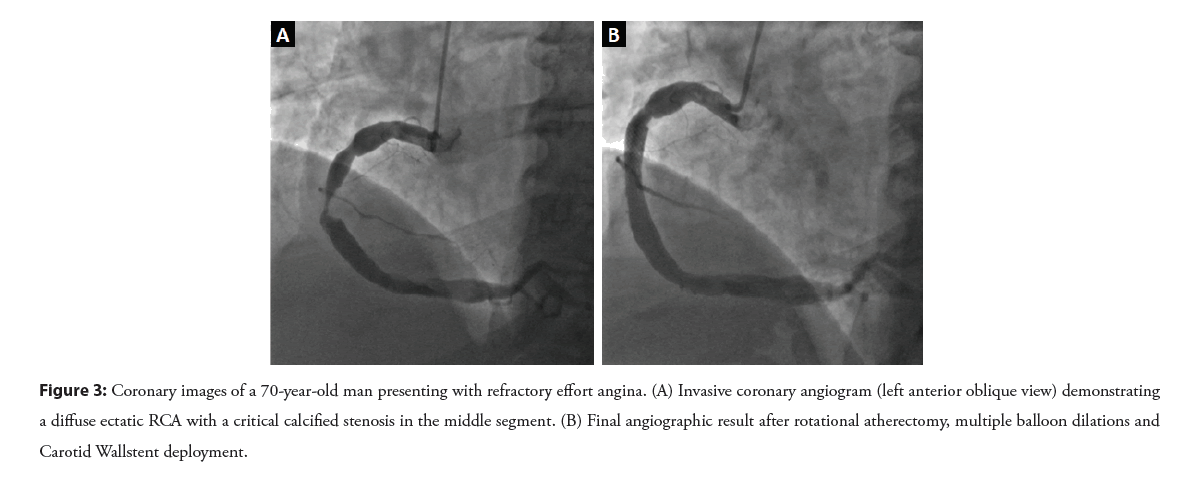 interventional-refractory