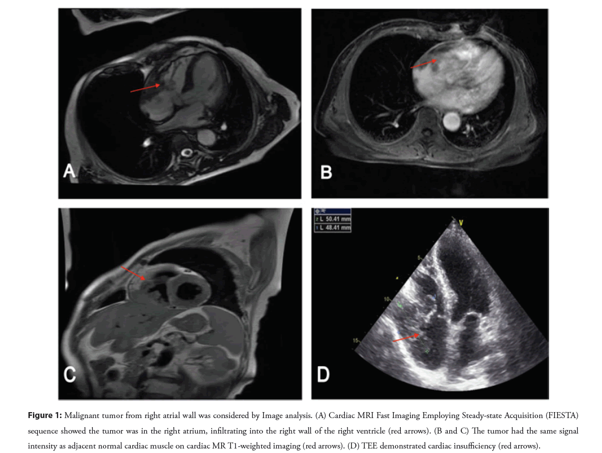 interventional-tumor