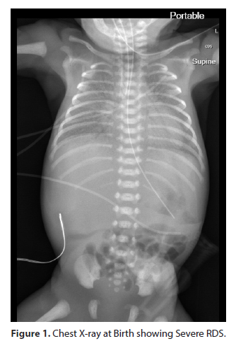 Late Use Of Surfactant In Neonatal Pneumonia