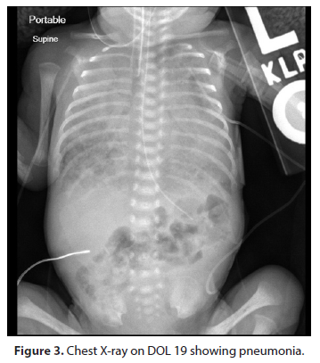 journal-neonatal-pneumonia