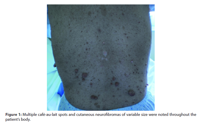 research-chronic-cutaneous