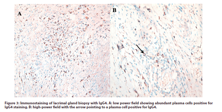 international-journal-lacrimal