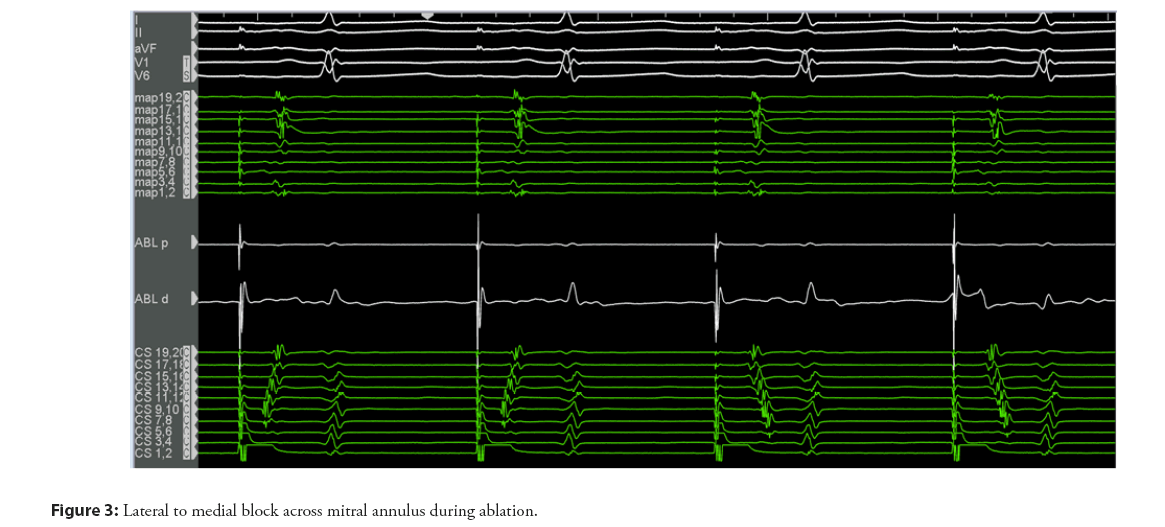 interventional-cardiology-annulus