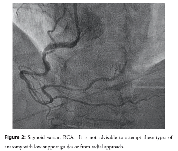 interventional-cardiology-attempt